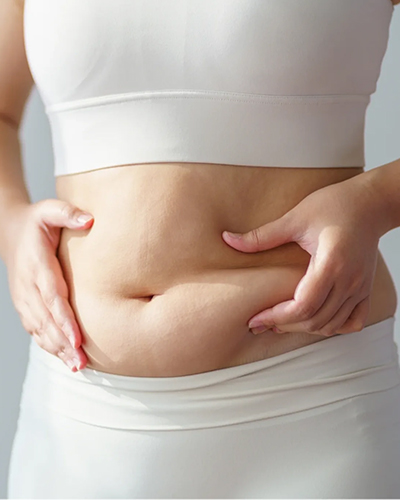 Abdominoplasty at Viswa Plastic Surgery Centre