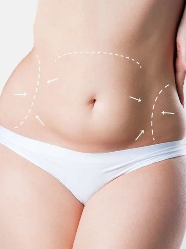 Tummy Tuck at Viswa Clinic