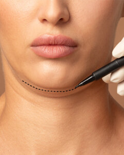 Chin Surgery Consultation at Viswa
