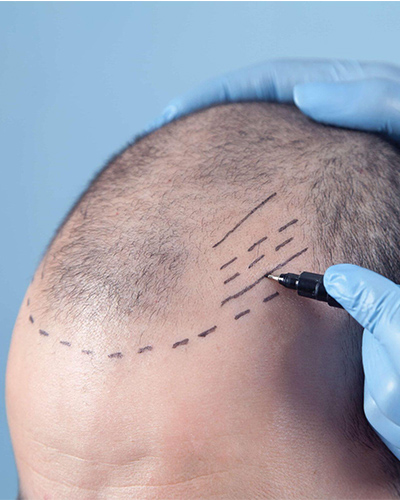 Hair Transplantation at Viswa