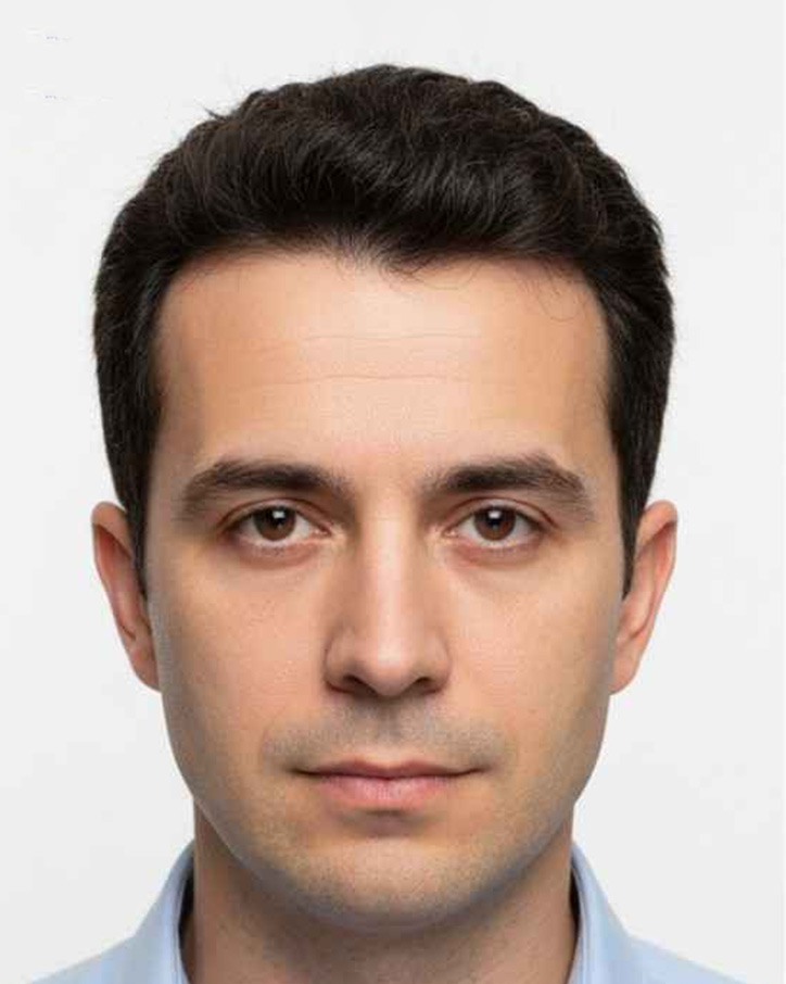 Hair Transplant Procedure at Viswa