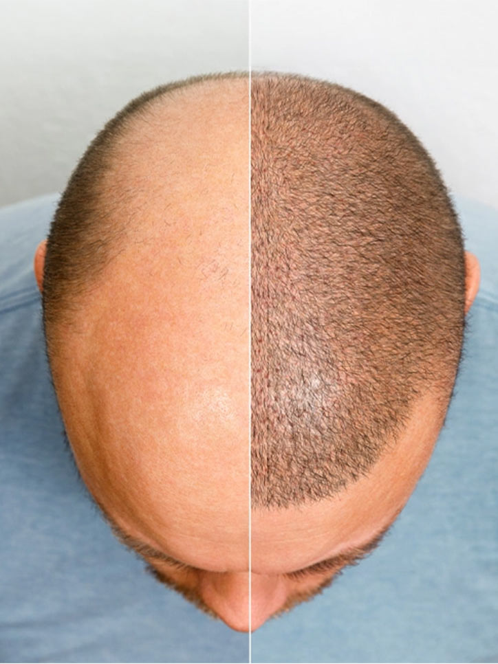 Hair Transplant Overview at Viswa Clinic