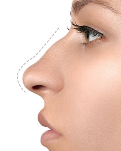 Rhinoplasty at Viswa Plastic Surgery Centre